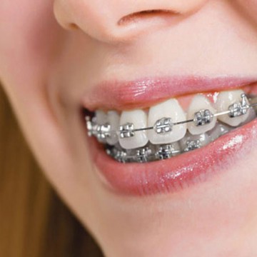 Niềng răng chỉnh nha