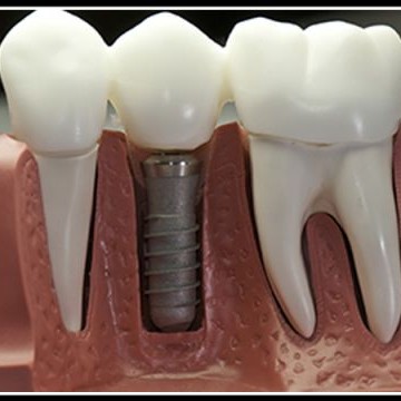 Phục hình implant