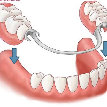Phục hình tháo lắp
