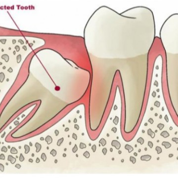 Tiểu phẫu răng khôn